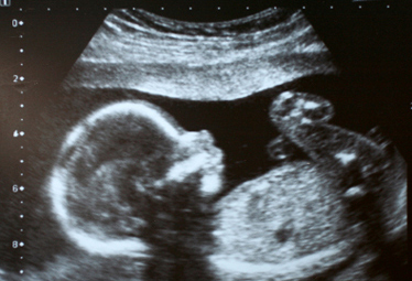 foetus-ultrasound-22weeks